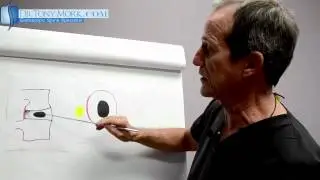 Disc Herniation Demonstration by Dr. Tony Mork