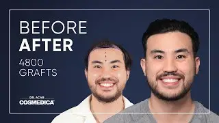 Hair Transplant in Turkey | Results | Dr. Acar | Cosmedica Clinic
