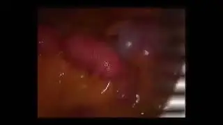 Peristaltismo intestinal