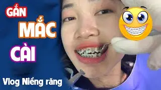 NGÀY ĐẦU TIÊN NIỀNG RĂNG NHƯ THẾ NÀO? | GẮN MẮC CÀI