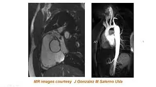 M mode Echocardiography and Spectral doppler review ASE