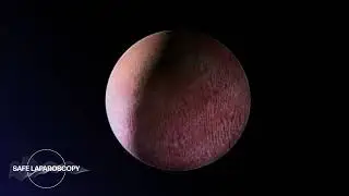 Management of a Urological Complication | Safe Laparoscopy