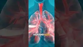 Breathe Easy: Understanding Bronchioloalveolar Carcinoma#medico #pathology