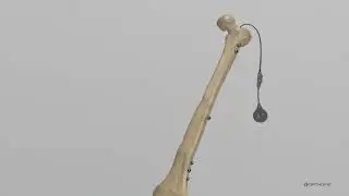 Fitbone Transport and Lengthening System
