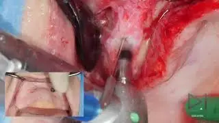 Atrophic maxilla implants N1 Nobel Biocare