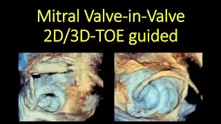 Mitral Valve-in-Valve ,2D/3D-TOE guided percutaneous procedure