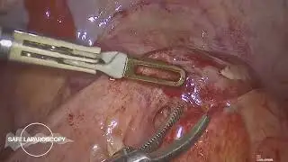 Postpartum acute appendicitis