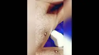 Лазерная эпиляция