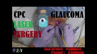 How to CPC: Transscleral Cyclophotocoagulation (CPC) Laser Glaucoma Sx
