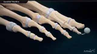 DynaNite® FlexWire