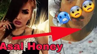 ASAL HONEYNI SKÒCHLAB QÒYIB JIDDIY JAROXAT YETKAZISHDI