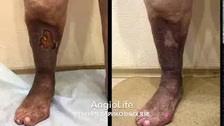 Лечение варикозных язв в АнгиоЛайф© Запорожье