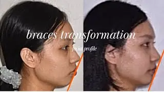 Braces Transformation - Before and After 牙套前后