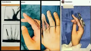 Liza Soberano Finger Injury!