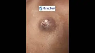 Drainage and Excision of Infected Sebaceous cyst on Back