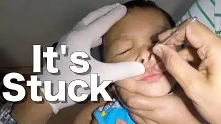 Plastic Bead Stuck Deep in Boy's Nose Removal