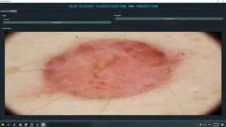 SKIN DISEASE CLASSIFICATION PYTORCH GUI | Machine Learning | Deep Learning | Python Project