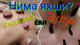 Нима яхши? Хиджама ёки зулук? Тошкент шаҳар (90)121-50-90