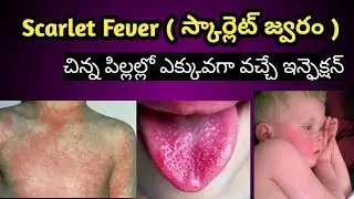 Scarlet Fever Symptoms and treatment in Telugu ( స్కార్లెట్ జ్వరం లక్షణాలు ,చికిత్స విధానం)