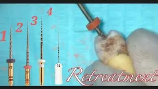 Endodontic Re-treatment From A to Z // How to remove old gutta percha