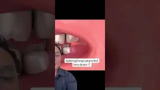 Menurut kalian gigi bungsu harus dicabut ? Video berikutnya aku kasih tau jawaban beserta alasanya