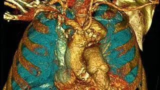 Subclavian steal syndrome (SSS). Bovine aortic arch. Aortic arch aneurysm. CT 3D
