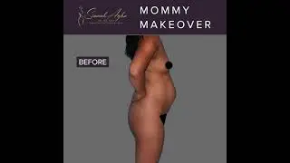 Mommy Makeover — Before & After