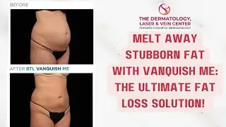 The Revolutionary Way to Shed Pounds: Vanquish ME Explained! #fatloss #bodycontouring #cosmeticderm
