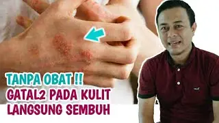 Obat Gatal Alami Pada Kulit Paling Ampuh dan Cepat Hilang