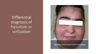 Medical Zone - Differential diagnosis of hirsutism or virilization