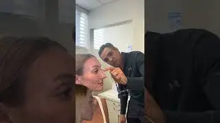 2 Months Post-Op From Rhinoplasty| Anthony Bared MD, FACS | Miami, FL