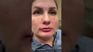 Lip Augmentation