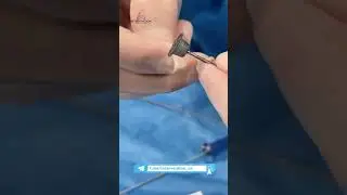 Batalov yo'li (OAП). Ochiq arterial yo'l