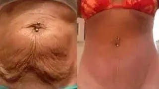 Eliminiert schlaffe Haut am Bauch in nur wenigen Tagen - Bewährte Methoden