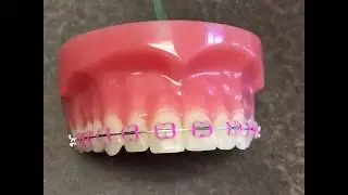 How to Take Care of Your Braces and Your Oral Hygiene: Nirenblatt Orthodontics