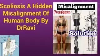 Scoliosis A Hidden Misalignment Of Human Body By DrRavi