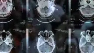 Headache Overview