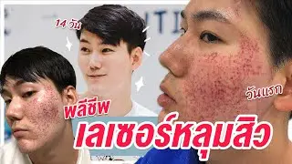 ยอมหน้าพัง 2 อาทิตย์  ทำเลเซอร์รักษาหลุมสิวที่ได้ผลที่สุด | สจ้วตพลีชีพ