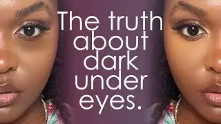TREATING DARK CIRCLES & PUFFY UNDEREYES - Causes & Treatments, An Esthetician's Guide