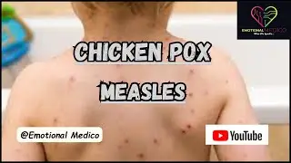 Chicken pox | Measles | Small pox | Community medicine