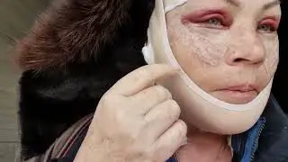 Моя пластическая операция . ТРЕТИЙ ДЕНЬ  с Докфайндеркорея в клинике View Plastic Surgery Korea