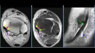 MRI Ankle Case 05