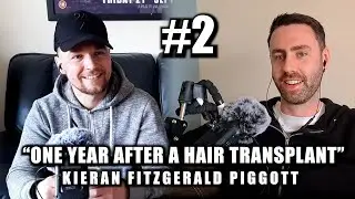 Podcast #2 "One year after a hair transplant"