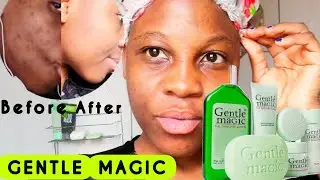 HOW I GOT RID OF DARK SPOTS ||GENTLE MAGIC SKINCARE ROUTINE