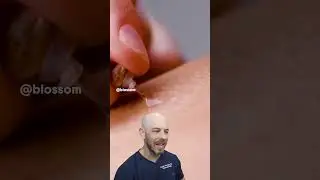 Fake skin tag removal!?🫣 Don't try this one at home! #fakeproduct #fake #drreacts #dermreacts