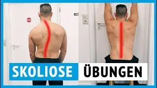 Scoliosis exercises from a physiotherapist (for home use)