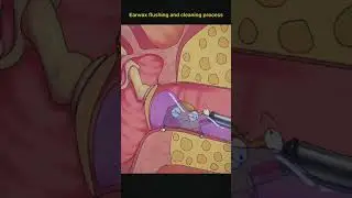 Earwax flushing and cleaning