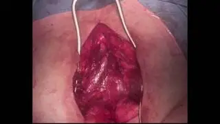 Pelvic Floor Reconstruction with Bilateral Gracilis Flaps After Extralevator APE