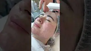 Коллаген +биоревилизант муолажаси #tashkent #интересно #uzbekistan #turkey #уходзалицом #collagen