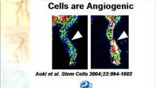 Stem Cell Therapy for Autism